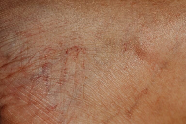 inflammation veineuse