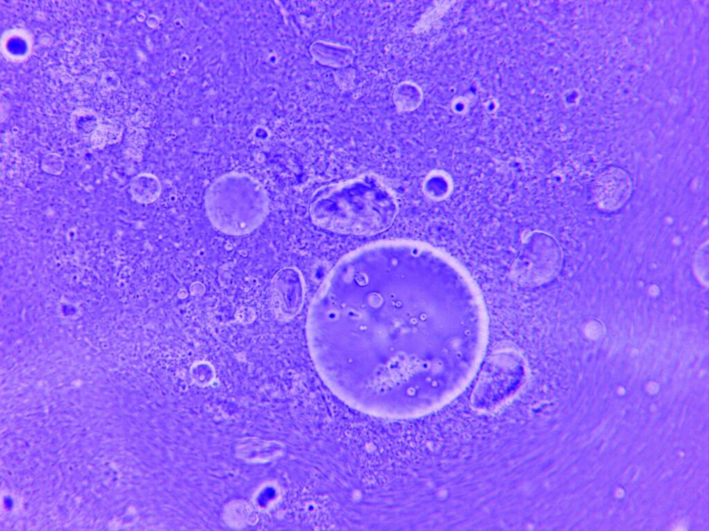 lymphocytes