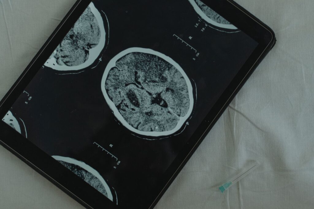 artère du cerveau