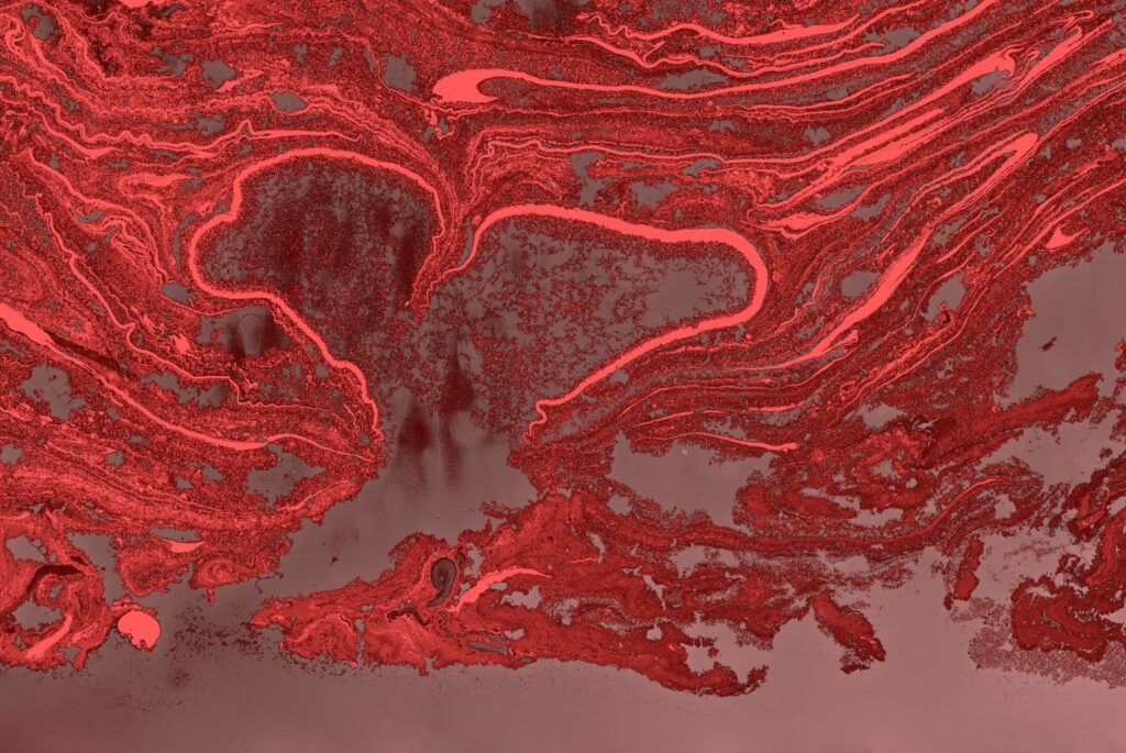 infarctus du myocarde