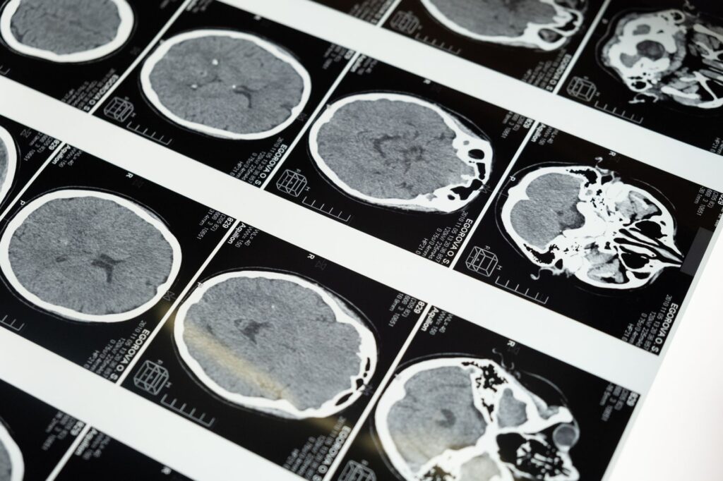 hémorragie dans le cerveau