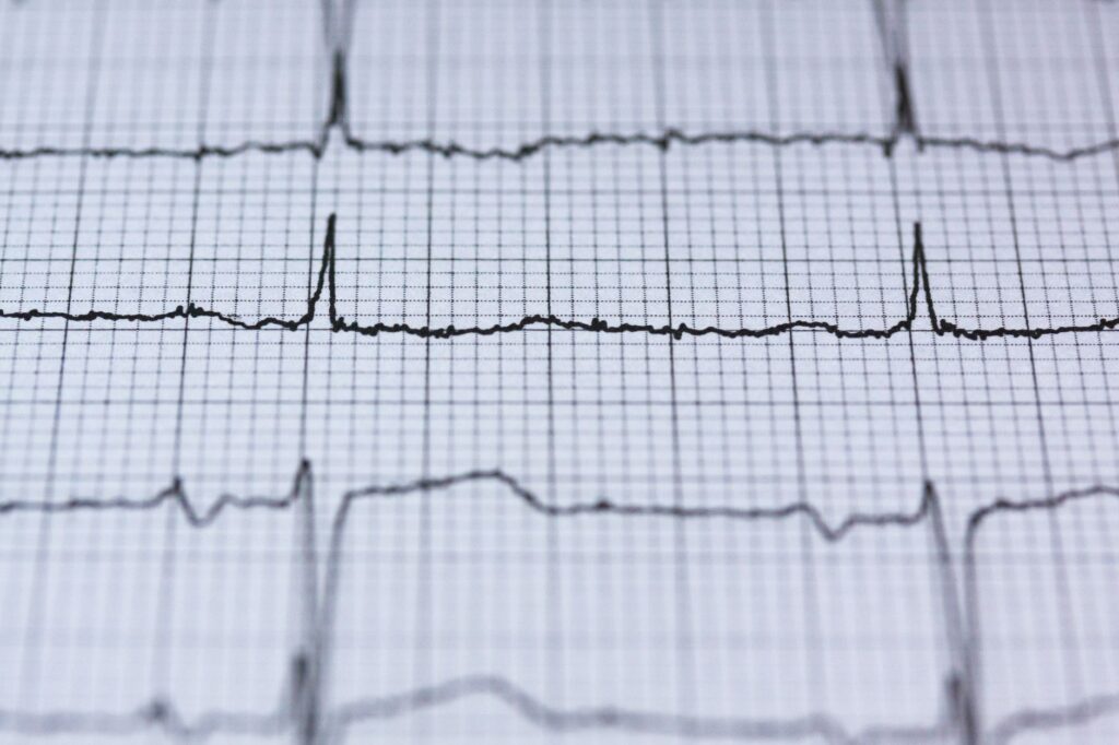 trouble de conduction cardiaque