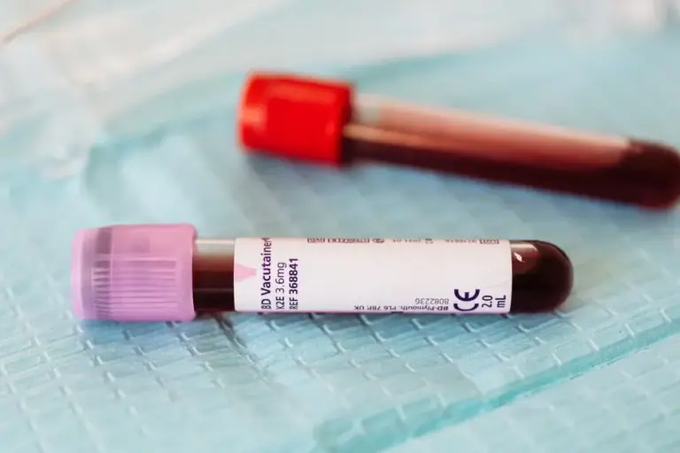 Angioedème : l'erreur qui retarde souvent le bon diagnostic
