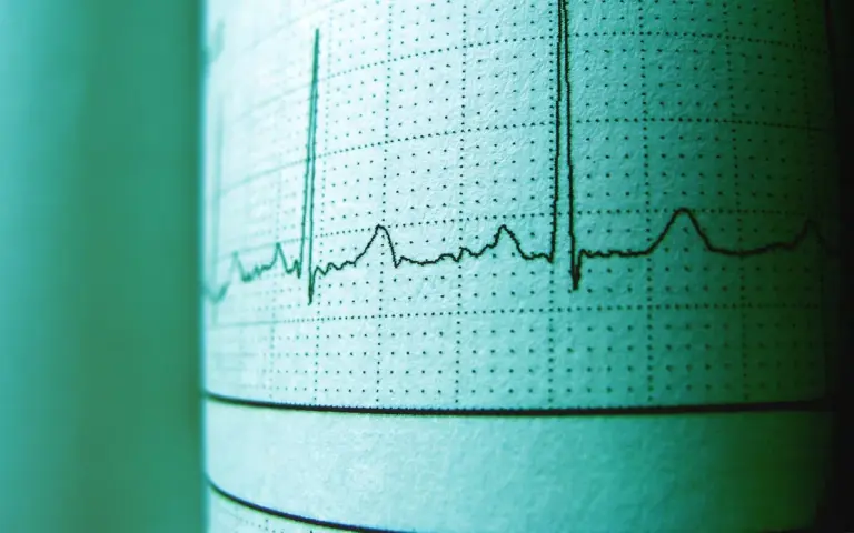 Minoca cardio : comprendre un infarctus du myocarde sans artères coronaires obstruées